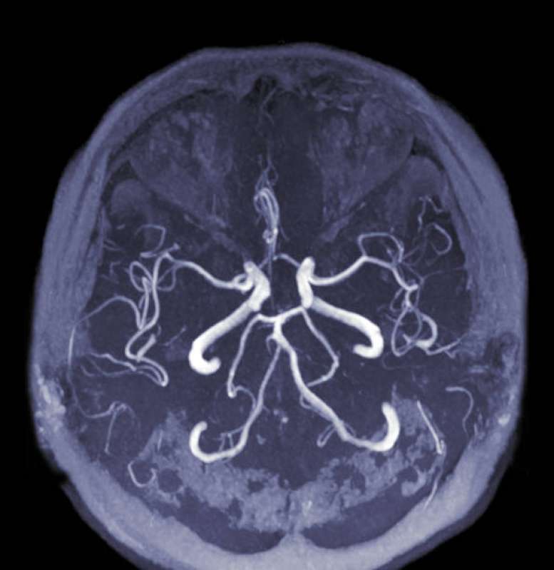 Agendar Exame de Angiorressonância Arterial do Crânio Carapicuíba - Angiorressonância dos Vasos Intracranianos