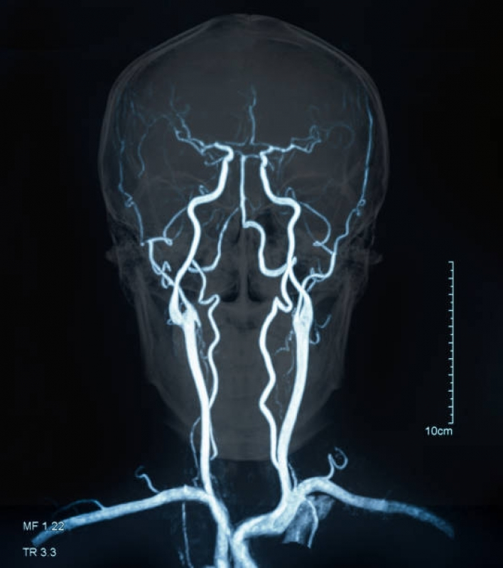 Agendar Exame de Angiorressonância Cerebral Arterial Cidade Ademar - Angiorressonância de Crânio