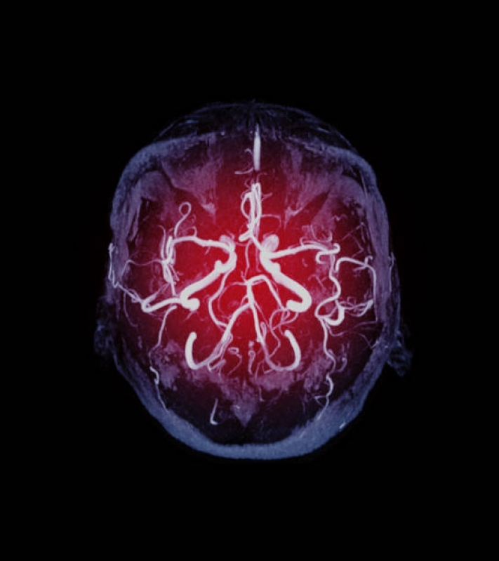 Agendar Exame de Angiorressonância de Encéfalo Guararema - Angiorressonância Cerebral Arterial