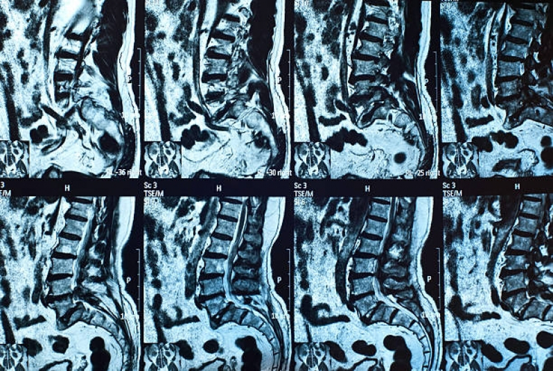 Agendar Exame de Ressonância Magnética Coluna Lombar Cantareira - Exame Ressonância de Crânio
