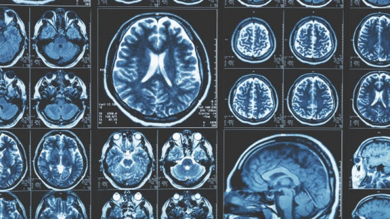 Agendar Exame de Ressonância Magnética do Crânio Pompéia - Ressonância Magnética do Cérebro