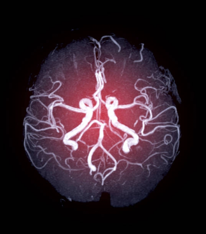 Angiorressonância Arterial do Crânio Onde Fazer Juquitiba - Angiorressonância dos Vasos Intracranianos