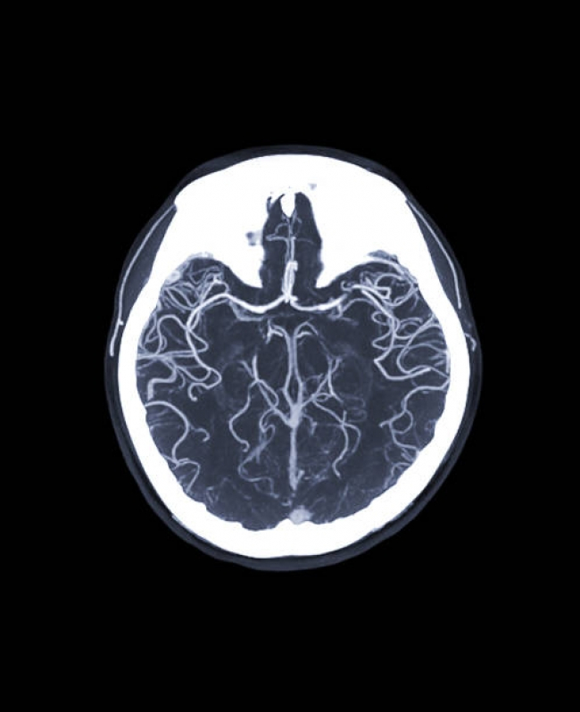 Angiorressonância Cerebral Arterial Ribeirão Pires - Angiorressonância dos Vasos Intracranianos