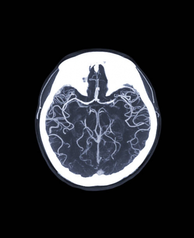 Angiorressonância Cerebral Arterial Parque São Domingos - Angiorressonância dos Vasos Cervicais