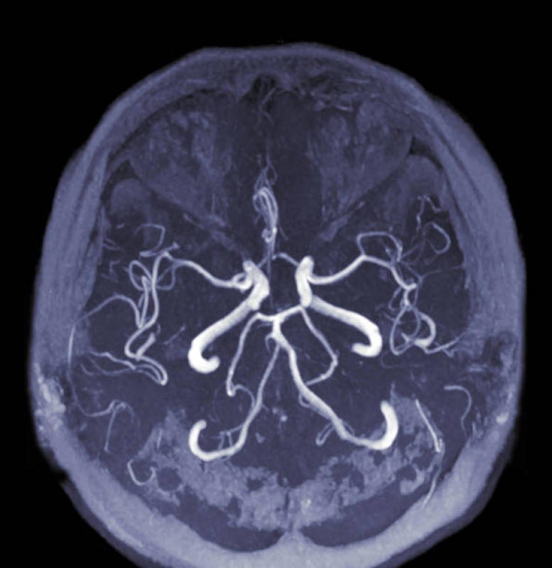 Angiorressonância Crânio Bela Vista - Angiorressonância Cerebral Arterial