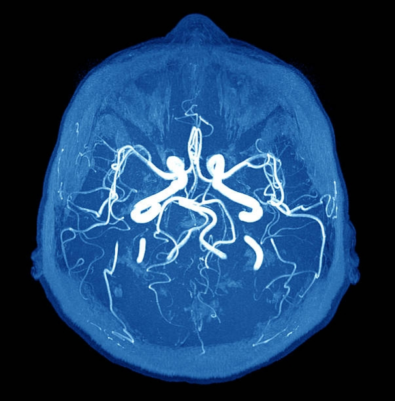 Angiotomografia Arterial de Crânio Agendar Granja Julieta - Angiotomografia Arterial de Crânio