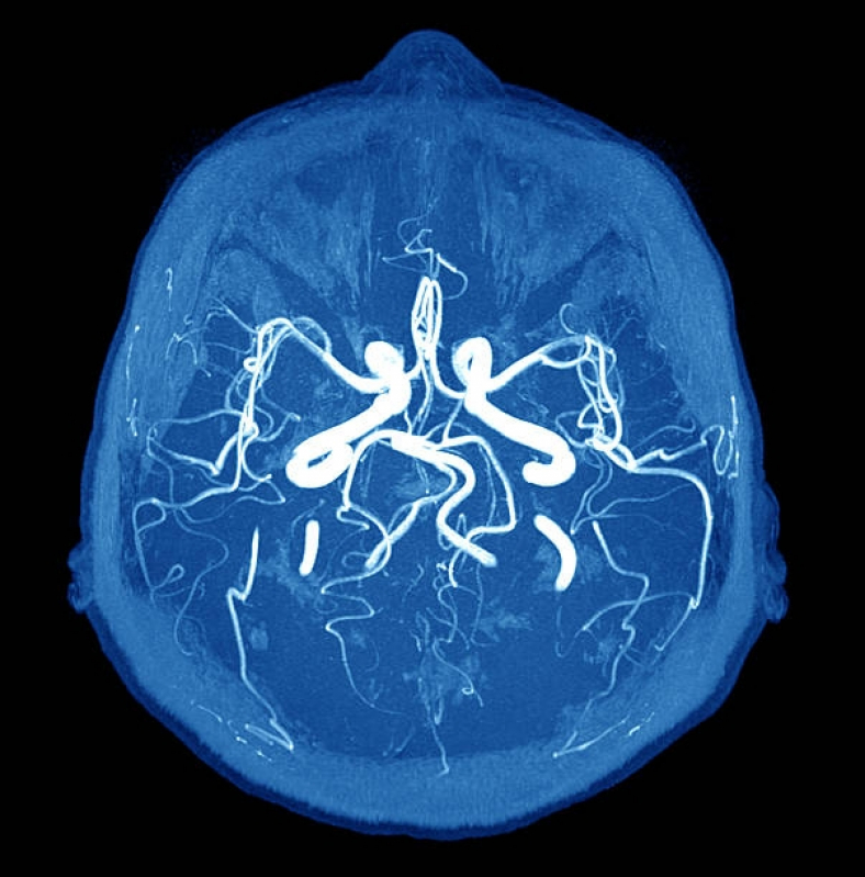 Angiotomografia Arterial de Crânio Agendar Mogi das Cruzes - Angiotomografia do Crânio