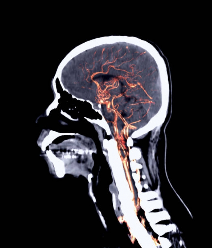 Angiotomografia Cerebral Jardim das Acácias - Angiotomografia de Tórax