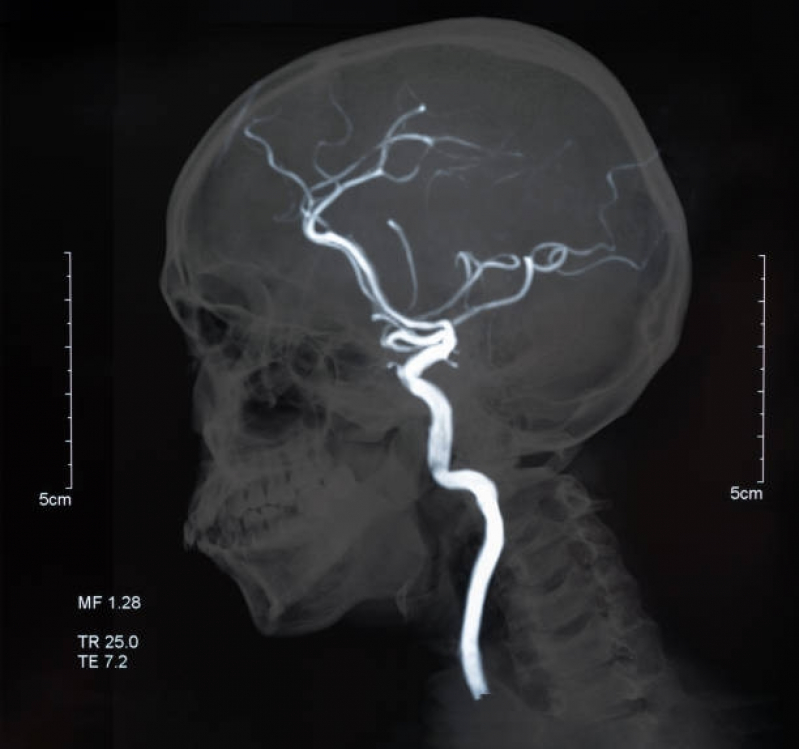 Clínica de Angiotomografia Arterial de Crânio Santa Cecília - Angiotomografia Cerebral