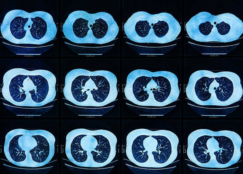 Clínica de Angiotomografia Pulmonar Embu Guaçú - Angiotomografia de Tórax