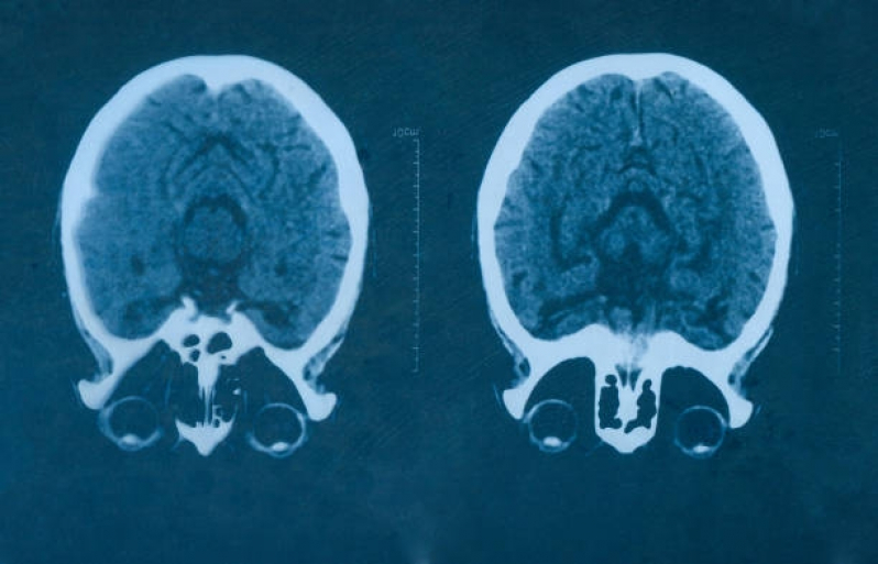 Clínica de Tomografia Cerebral Biritiba Mirim - Tomografia de Crânio