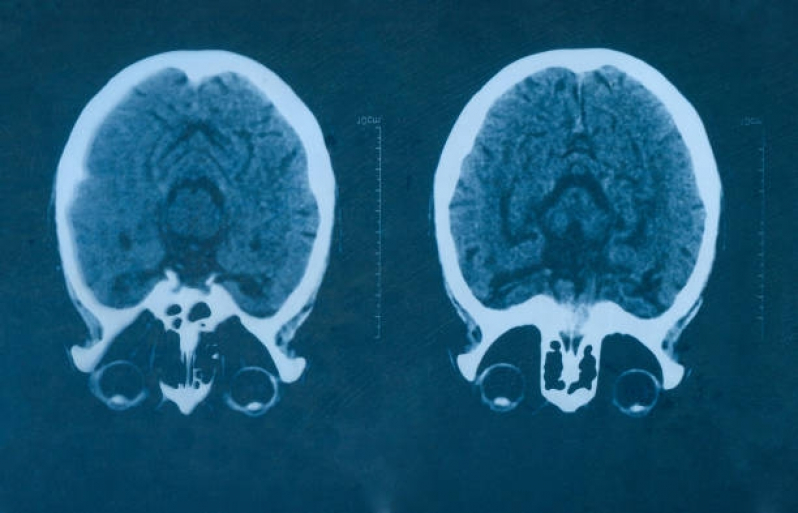 Clínica de Tomografia Cerebral Brasilândia - Tomografia Cerebral