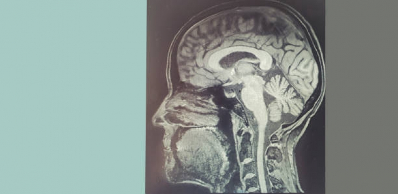 Clínica de Tomografia da Face Pompéia - Tomografia do Crânio