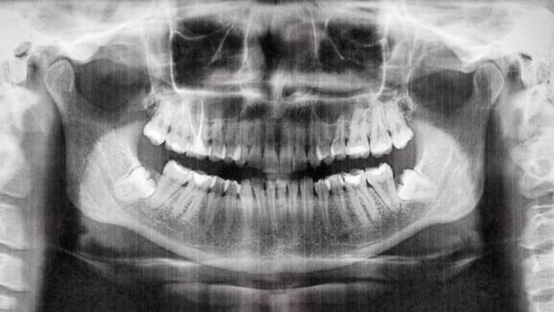 Clínica de Tomografia Odontológica Socorro - Tomografia do Crânio