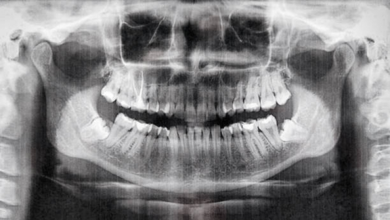 Clínica de Tomografia Odontológica Freguesia do Ó - Tomografia Pulmonar