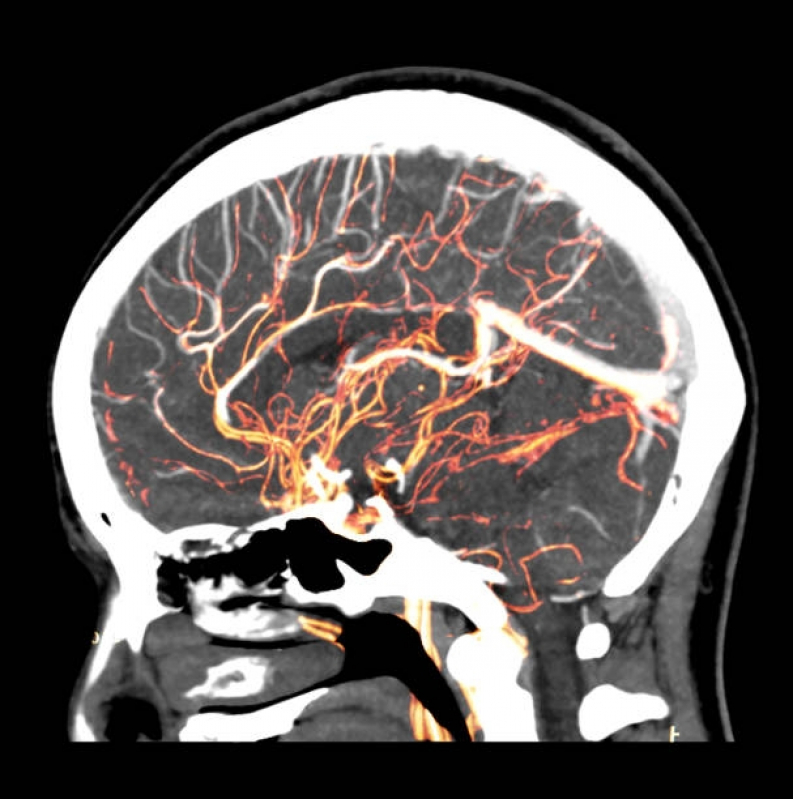 Exame de Angiotomografia Arterial de Crânio Brás - Angiotomografia Pulmonar