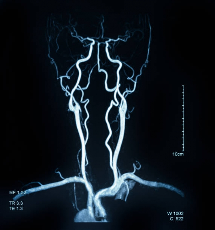 Exame de Angiotomografia Cerebral Barueri - Angiotomografia Arterial de Crânio