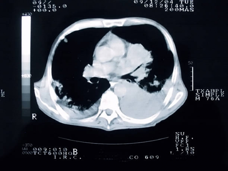 Exame de Angiotomografia Pulmonar Saúde - Angiotomografia de Crânio