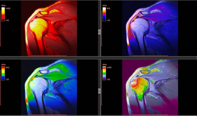 Exame de Ressonância do Ombro Agendar Moema - Exame Ressonância Magnética do Crânio