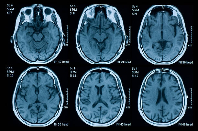 Exame de Tomografia Cerebral Jardim Guedala - Tomografia do Tórax