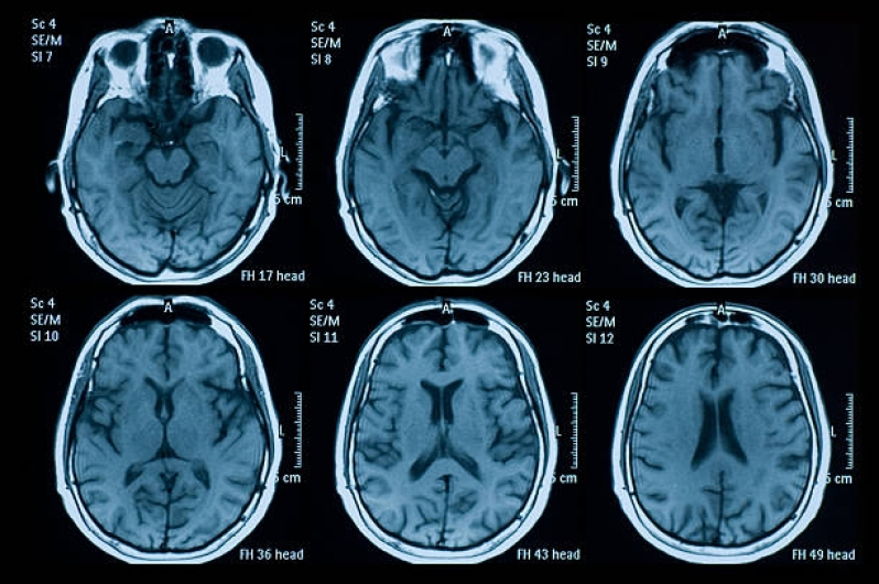 Exame de Tomografia Cerebral República - Tomografia Cerebral