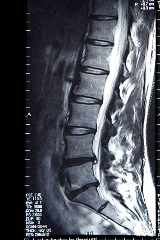 Exame de Tomografia da Coluna Lombar Santana de Parnaíba - Tomografia Cerebral