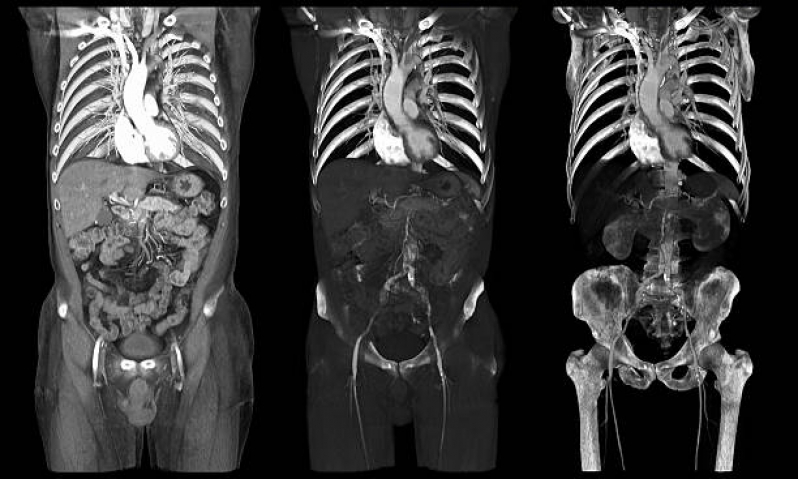 Exame Tomografia Abdome Total Consolação - Exame Tomografia Maxilar