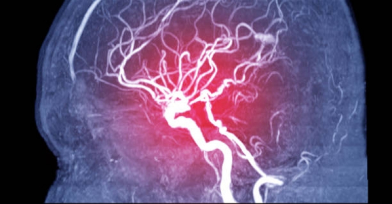 Marcar Exame de Angiorressonância Arterial do Crânio Cambuci - Angiorressonância Cerebral Arterial