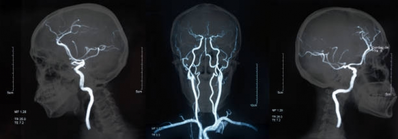 Marcar Exame de Angiorressonância Cerebral Arterial Guarulhos - Angiorressonância Arterial do Crânio