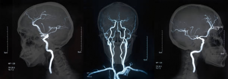 Marcar Exame de Angiorressonância Cerebral Arterial Chora Menino - Angiorressonância de Crânio