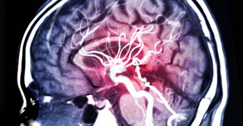 Marcar Exame de Angiorressonância Cerebral Butantã - Angiorressonância Arterial do Crânio
