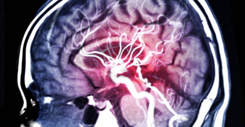 Marcar Exame de Angiorressonância Cerebral Centro - Angiorressonância de Crânio