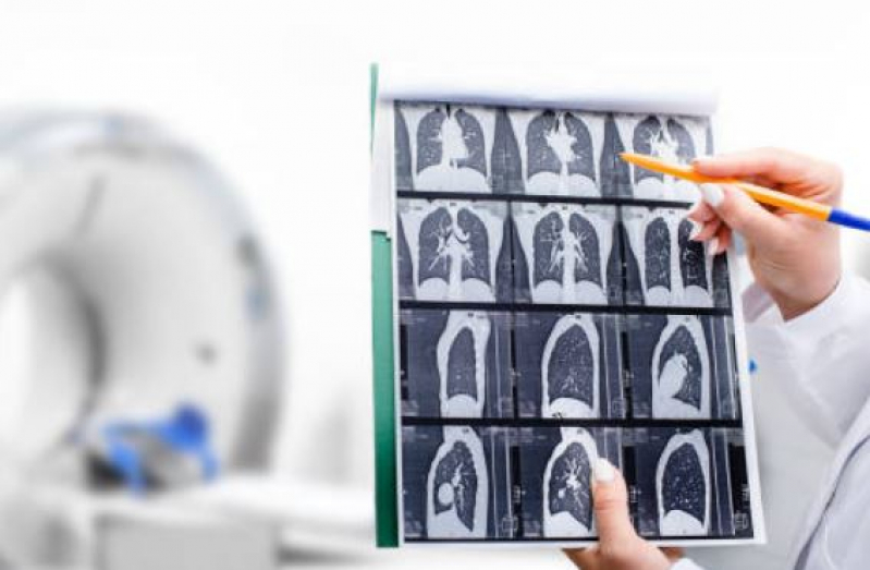 Marcar Tomografia Computadorizada 3d Embu Guaçú - Tomografia Computadorizada do Pulmão