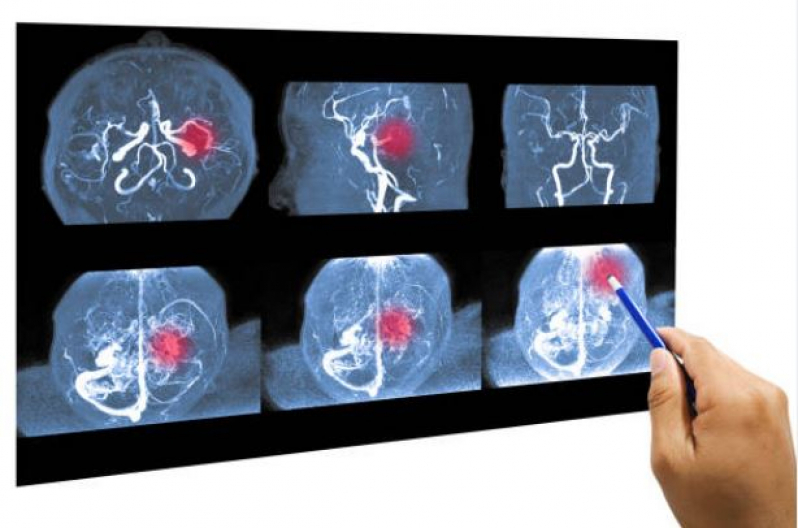 Onde Faz Angiorressonância Magnética Sé - Angioressonancia de Crânio