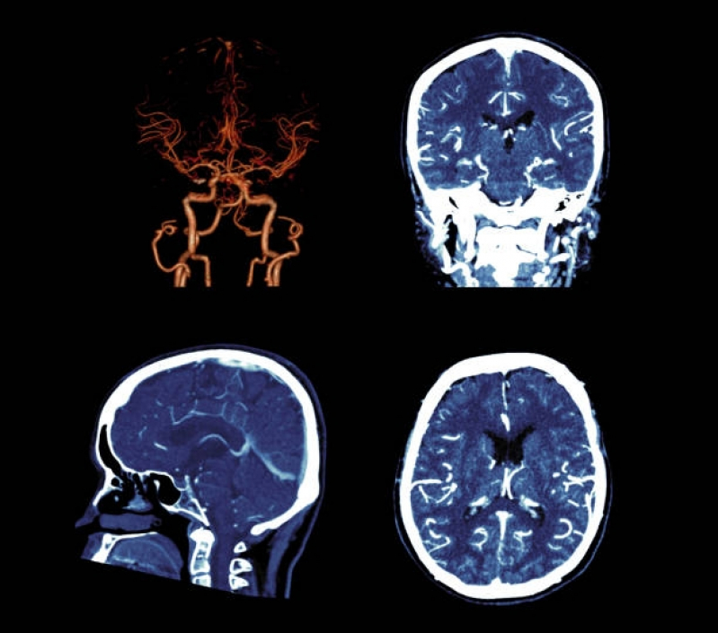 Onde Faz Tomografia Computadorizada do Crânio Ibirapuera - Tomografia Computadorizada da Cabeça