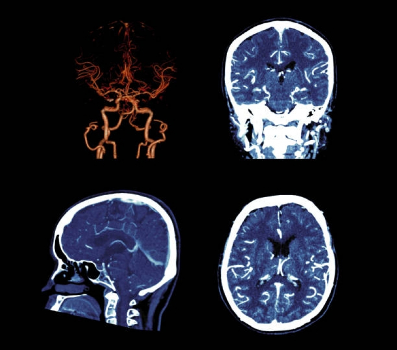 Onde Faz Tomografia Computadorizada do Crânio Guararema - Tomografia Computadorizada de Crânio