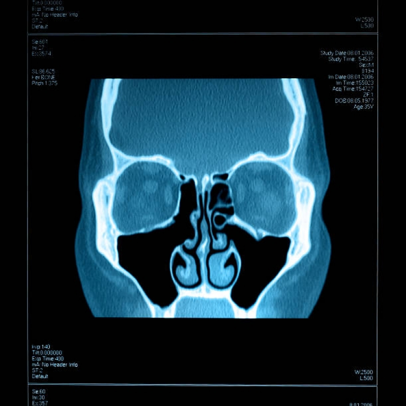 Onde Faz Tomografia Computadorizada dos Seios da Face Jardim São Paulo - Tomografia Computadorizada do Crânio