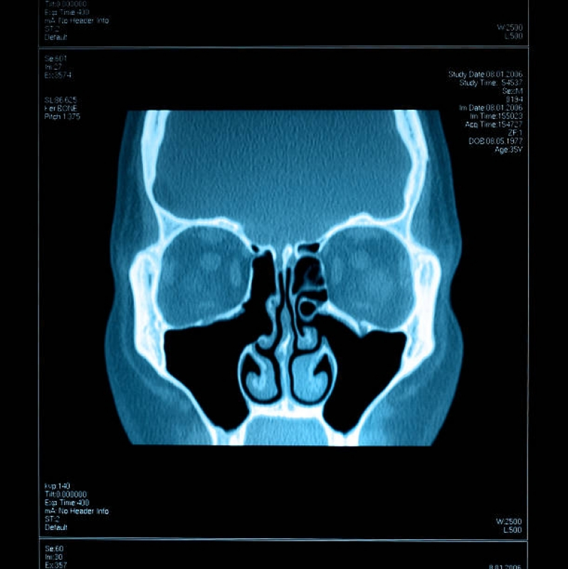 Onde Faz Tomografia Computadorizada dos Seios da Face Moema - Tomografia Computadorizada da Cabeça