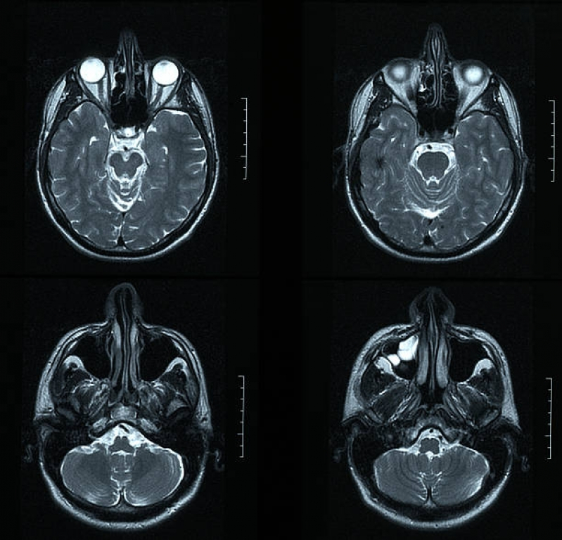 Onde Fazer Tomografia Computadorizada do Crânio Bela Cintra - Tomografia Computadorizada da Coluna Lombar