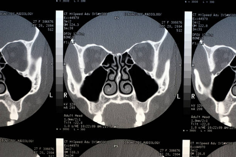 Onde Fazer Tomografia Computadorizada dos Seios da Face M'Boi Mirim - Tomografia Computadorizada de Crânio