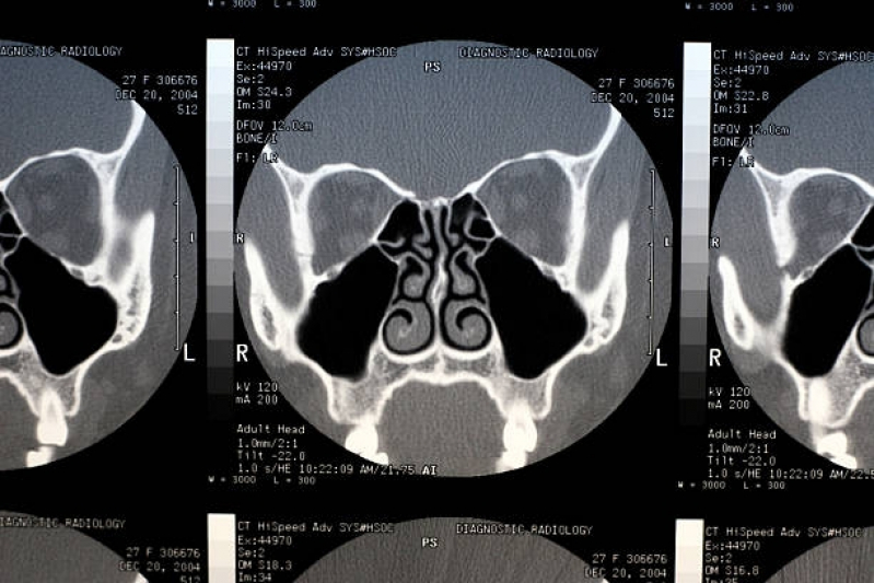 Onde Fazer Tomografia Computadorizada dos Seios da Face Guarulhos - Tomografia Computadorizada do Crânio