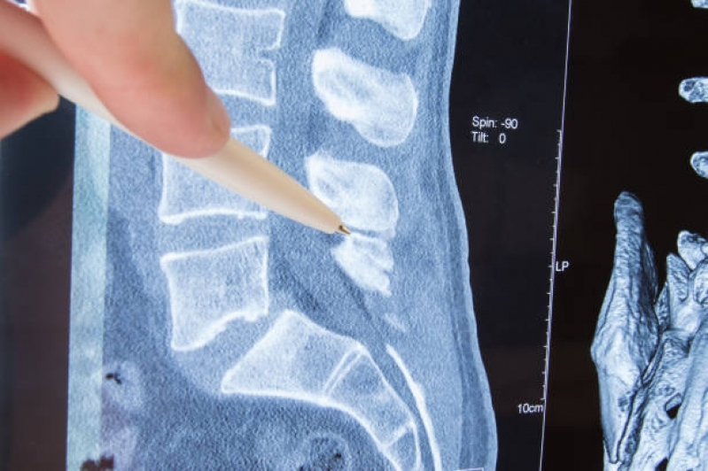 Ressonância Magnética da Coluna Clínicas Ribeirão Pires - Ressonância Magnética da Coluna Lombar