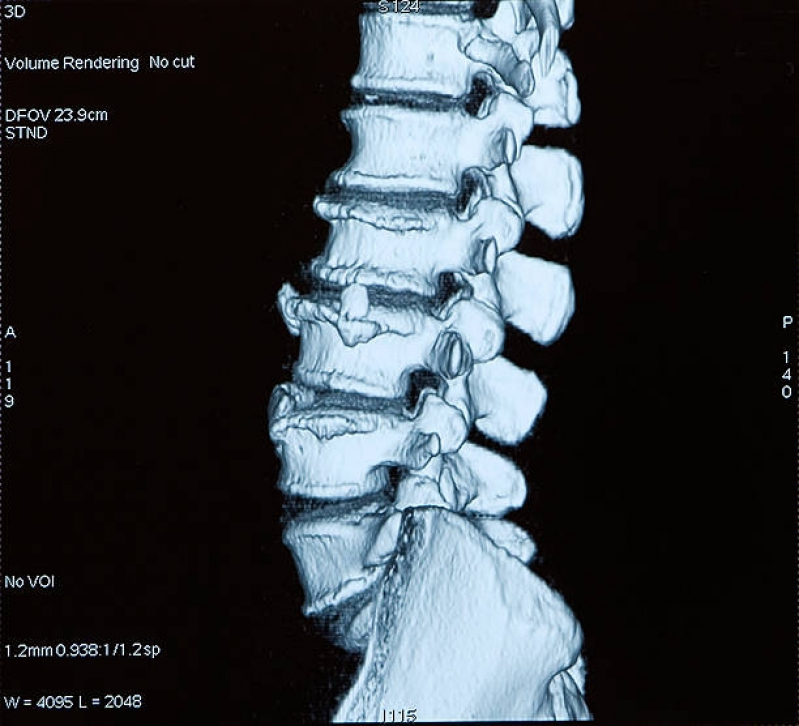 Ressonância Magnética da Coluna Jardim Everest - Ressonância Magnética da Coluna Lombar