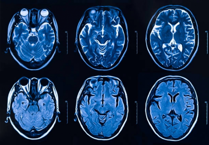 Ressonância Magnética do Cérebro Jardim América - Ressonância Magnética do Encéfalo