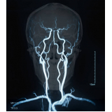 agendar exame de angiorressonância cerebral arterial Santa Cruz