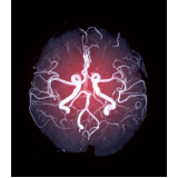 Angiorressonância dos Vasos Intracranianos