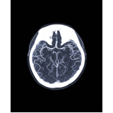 angiorressonância cerebral arterial São Lourenço da Serra