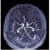 angiorressonância dos vasos intracranianos Mauá