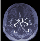 angiorressonância dos vasos intracranianos Brooklin