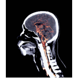 Angiotomografia Cerebral